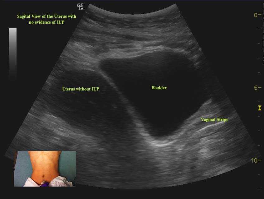 sagital ectopic with image